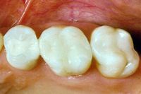 Cerec-Inlay